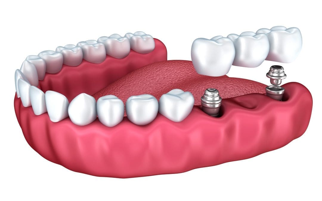 8 Impressive Benefits of Dental Implants