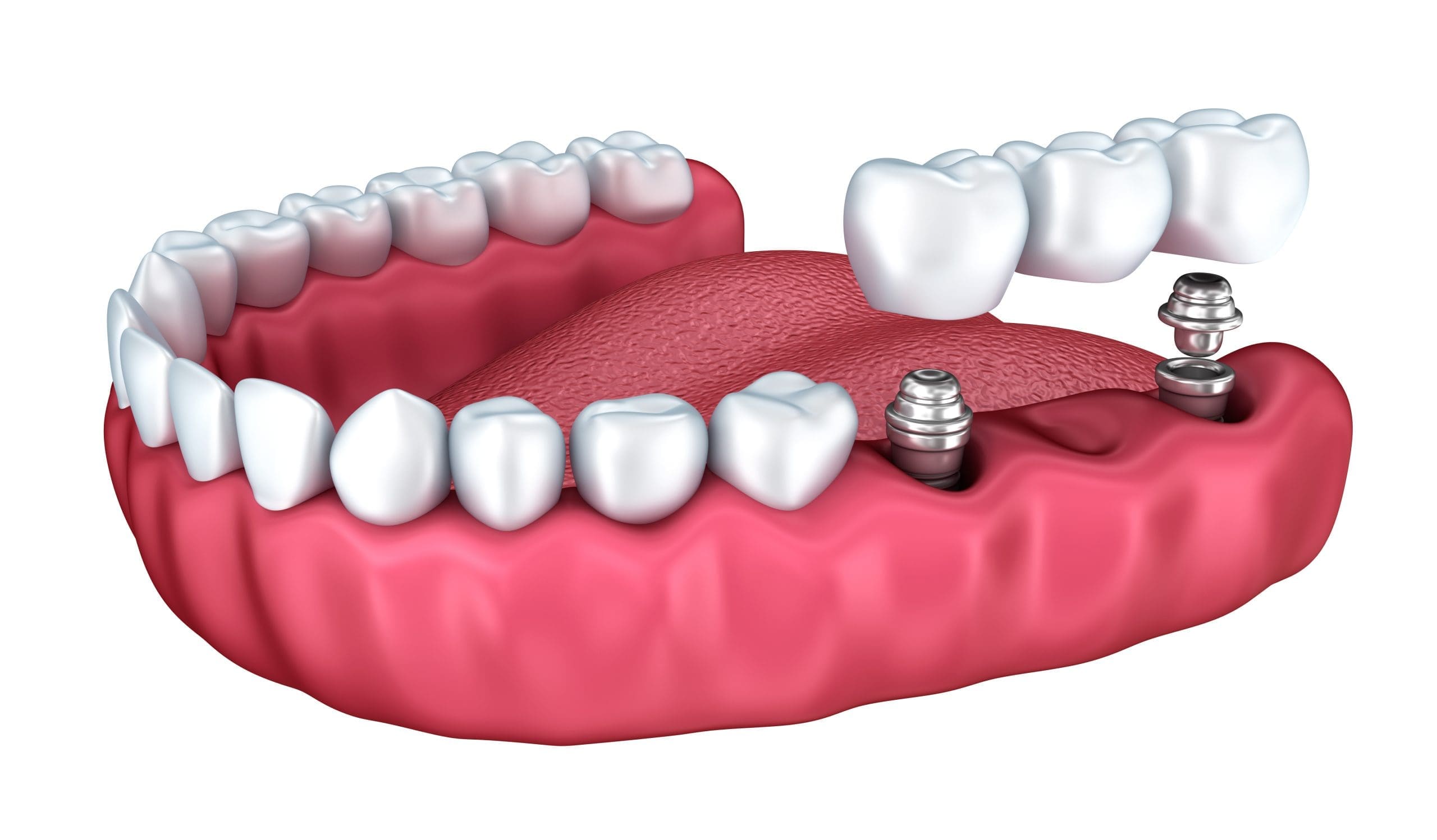 8 Impressive Benefits of Dental Implants