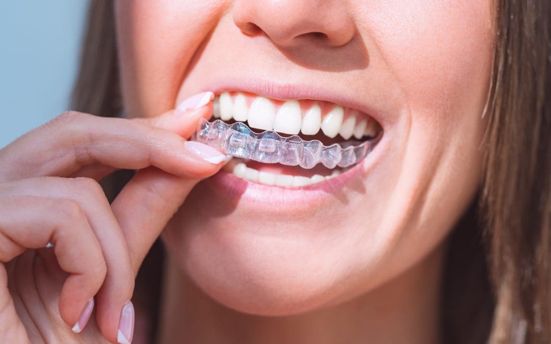 Using Invisalign Cleaning Crystals: A Simple Guide